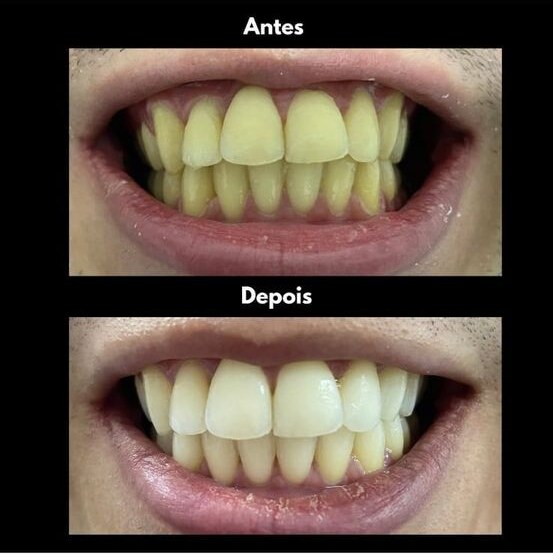 Caso clínico de clareamento dental realizado na Oral Clinic, comparativo de antes e depois