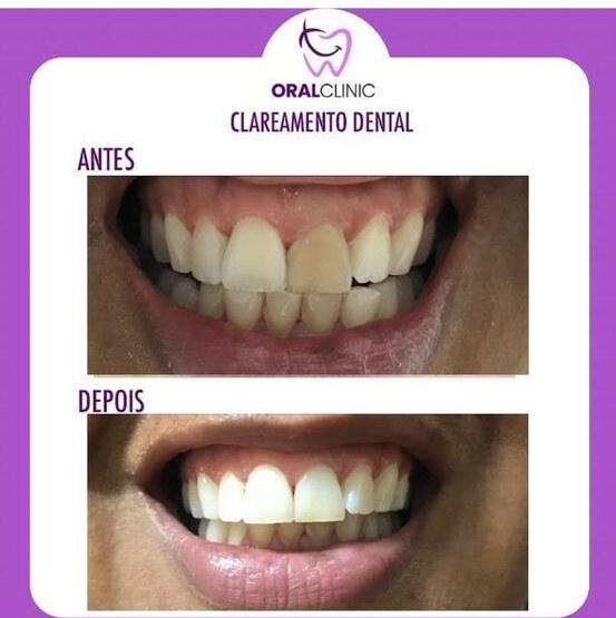Caso clínico de clareamento dental realizado na Oral Clinic, comparativo de antes e depois